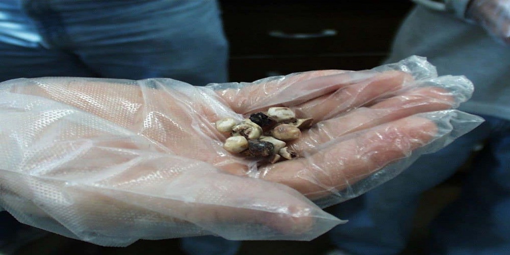 آیا سنگ کیسه صفرا خطرناک است؟