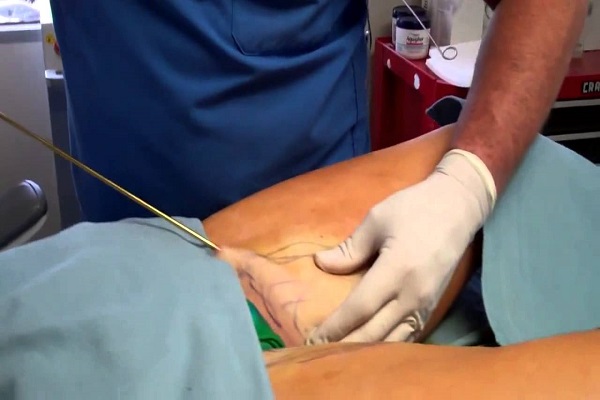 نکاتی قبل و بعد از جراحی شکم