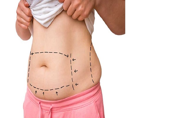 انواع جراحیهای لاغری شکم
