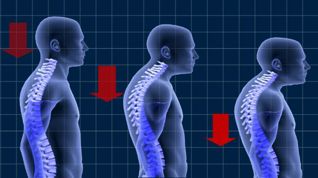 کشش کمر یک ورزش اصلاحی قوز کمر