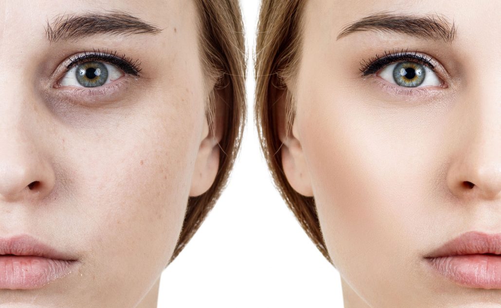 سیاهی زیر چشم