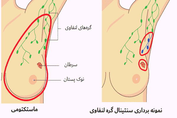 ماستکتومی پستان