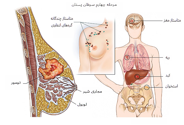 علائم سرطان پستان