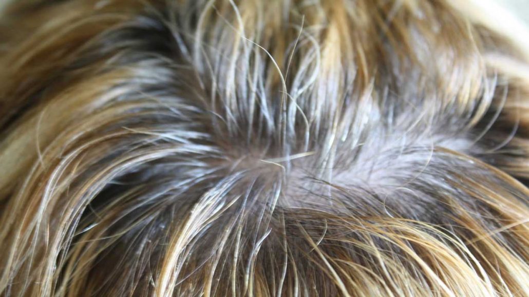 یکی دیگر از راه‌های درمان سفیدی مو استفاده از چای سیاه است 