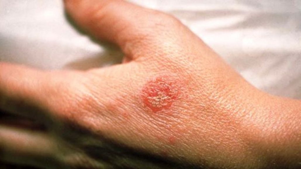 درمان اگزمای شدید پوستی