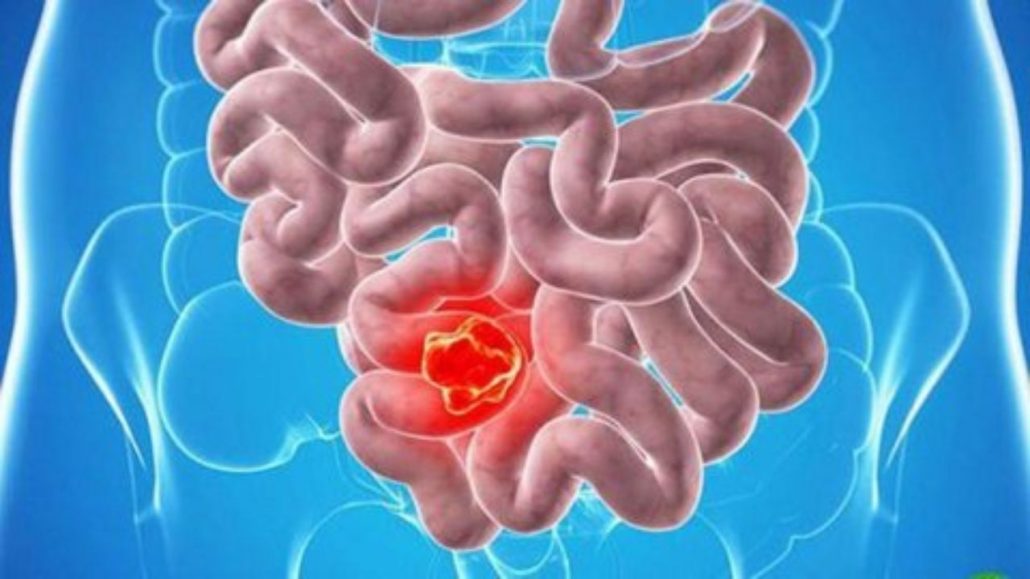 بررسی علائم هشدار دهنده سرطان روده