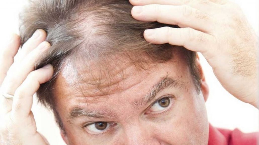 دلایل ریزش مو در مردان / علت ناگهانی ریزش 