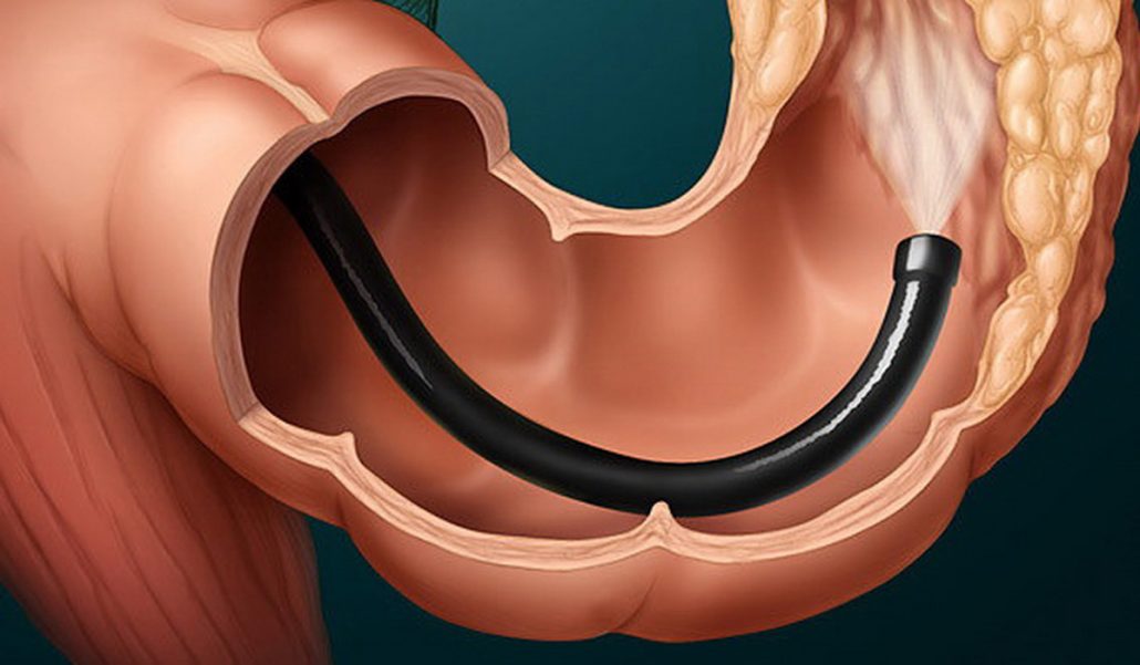 علائم هشدار دهنده سرطان روده / علائم اولیه و در مرحله حاد