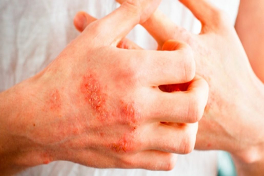 اگزمای حاد پوستی