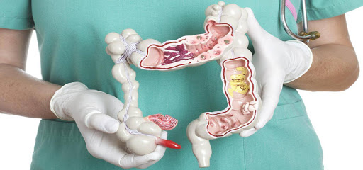 علائم هشدار دهنده سرطان روده / علائم سرطان روده در جوانان