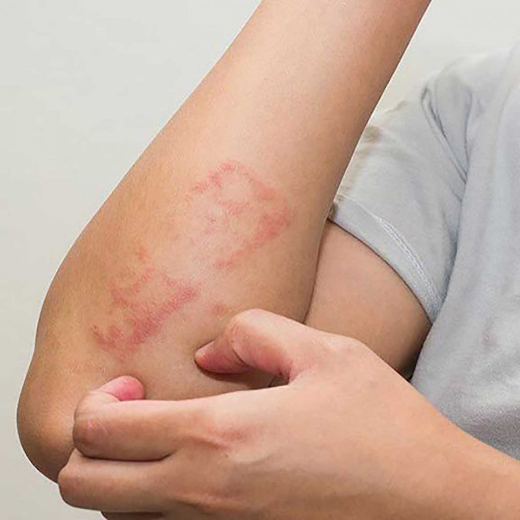 اگزمای شدید پوستی / علائم+ راه های درمان