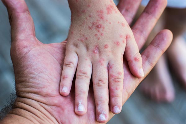 Psoriasis-in-children