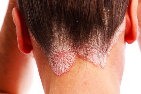 Psoriasis-of-the-head