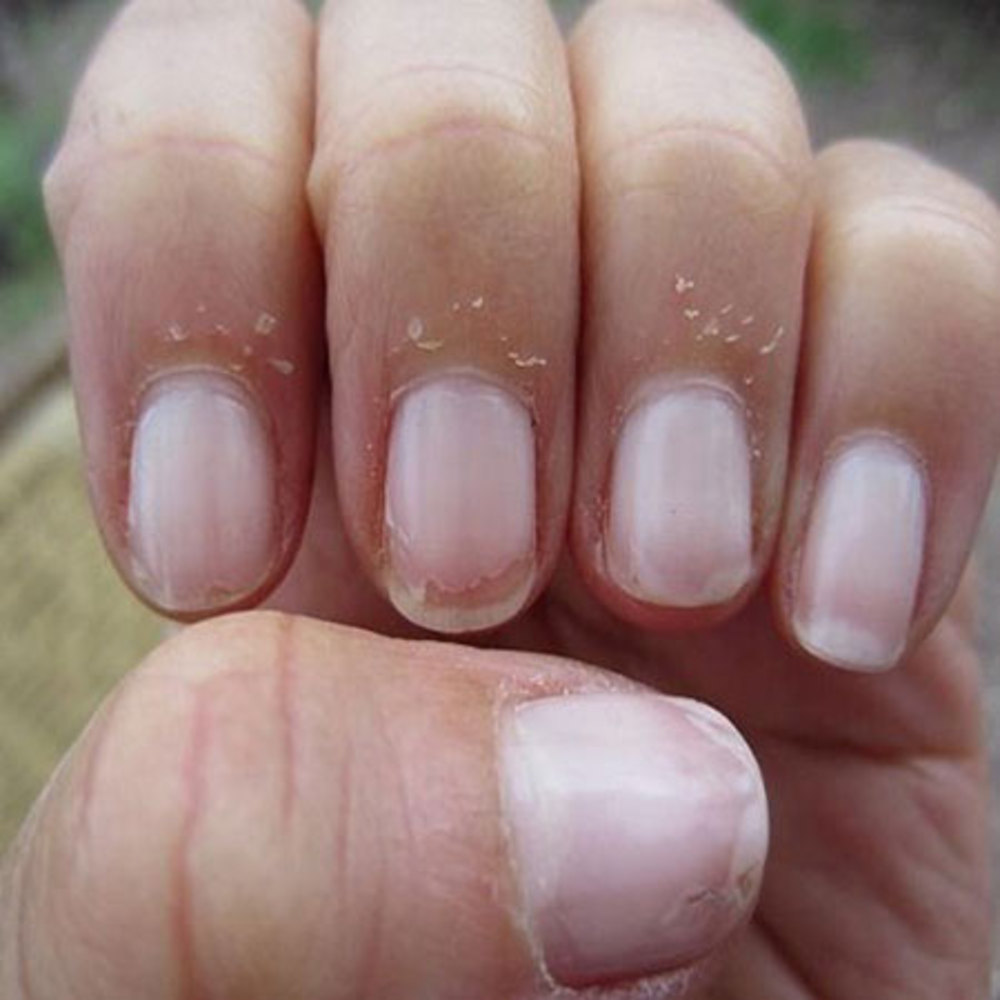 دلیل پوسته شدن دور ناخن چیست؟ | راههای ترمیم پوست دور ناخن
