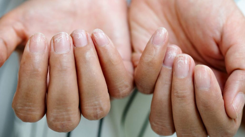 پوسته شدن دور ناخن/ درمان کنده شدن پوست اطراف ناخن/ ترمیم پوست دور ناخن