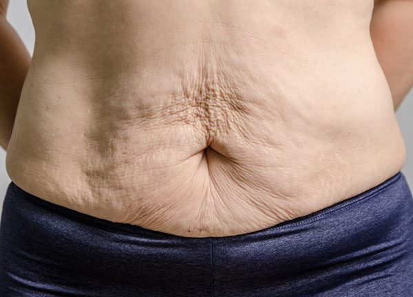 پوست صورتم شل شده / درمان افتادگی پوست شکم 