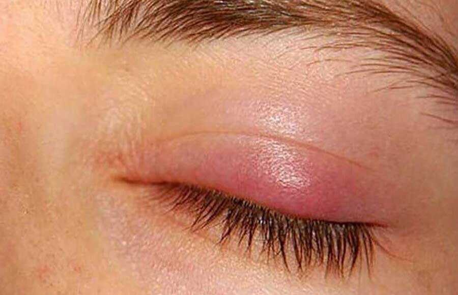 گل مژه یا کیسه چربی زیر چشم در اثر عوامل زیر ایجاد می‌شود: