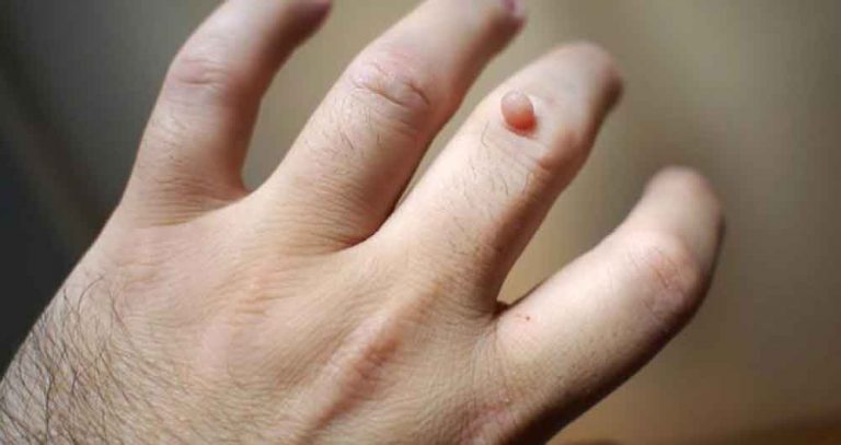 یکی دیگر از راه‌های درمان زگیل صورت در طب سنتی استفاده از موم است. 