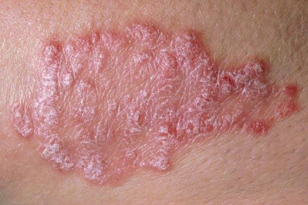 How-to-diagnose-lupus