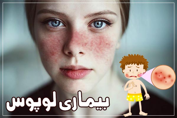 Lupus-disease-and-its-symptoms