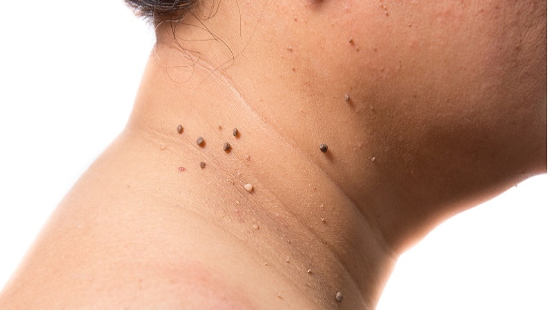 در ادامه به طور مفصل به درمان زگیل صورت در طب سنتی می‌پردازیم.