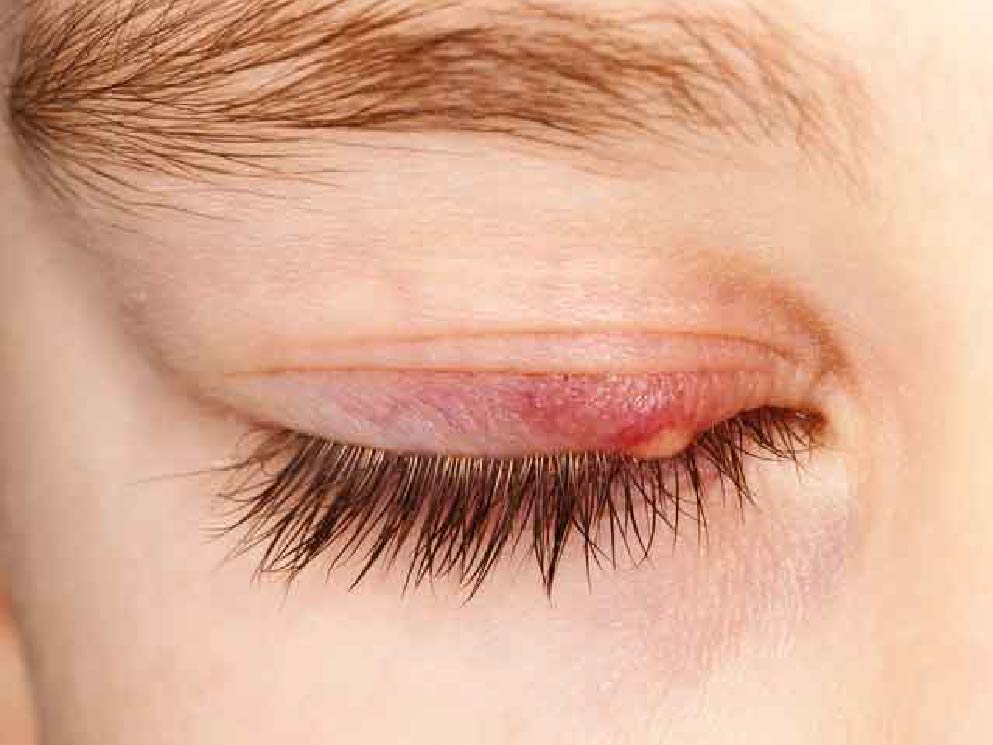 گل مژه چشم به صورت یک کیسه چربی زیر چشم ظاهر می‌شود