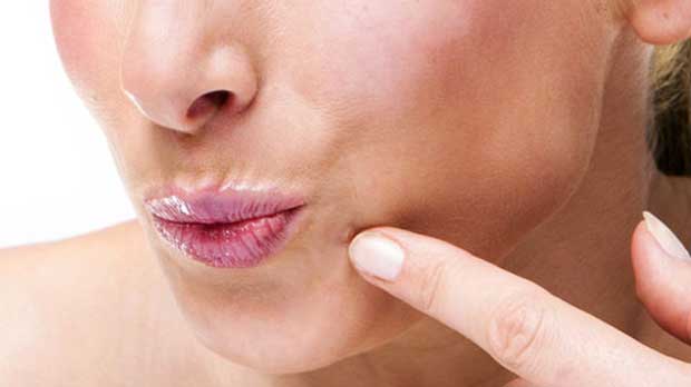 درمان زگیل صورت در طب سنتی استفاده از قرص ویتامین C 