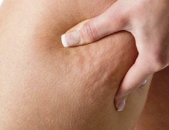 سلولیت پشت ران یک بیماری پوستی بی‌خطر است