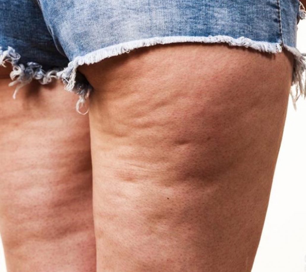 بهترین راه درمان سلولیت پشت ران با ورزش