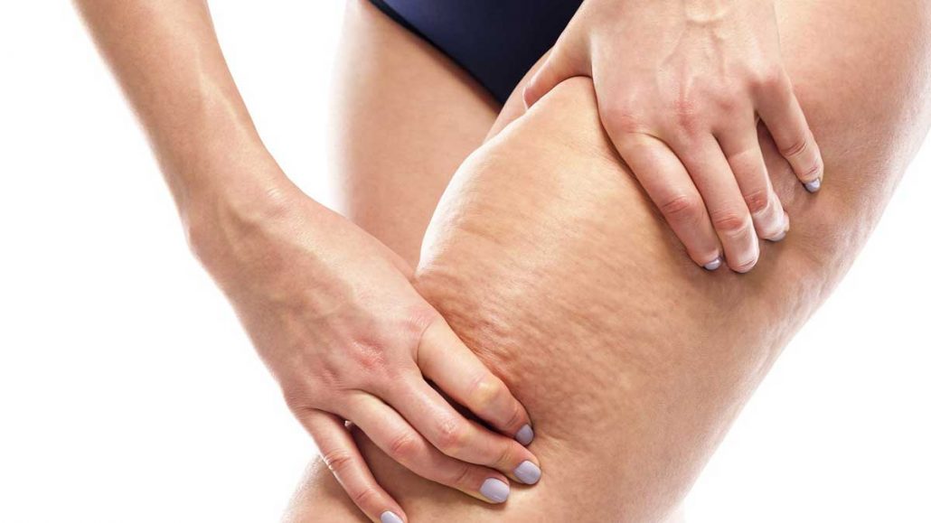 دلایل ایجاد سلولیت پشت ران