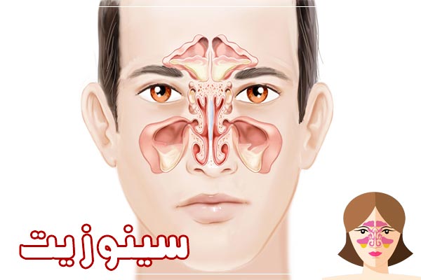 سینوزیت چیست