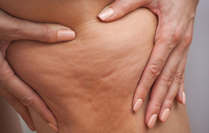 درمان قطعی سلولیت با ساده ترین روش ها در خانه