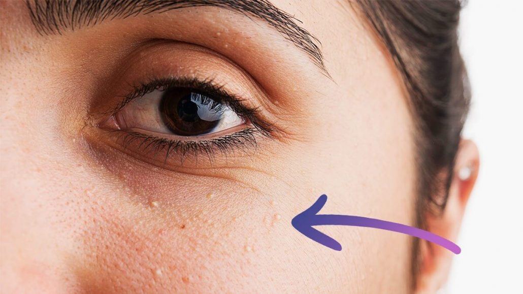 درمان گیاهی دانه های چربی زیر چشم