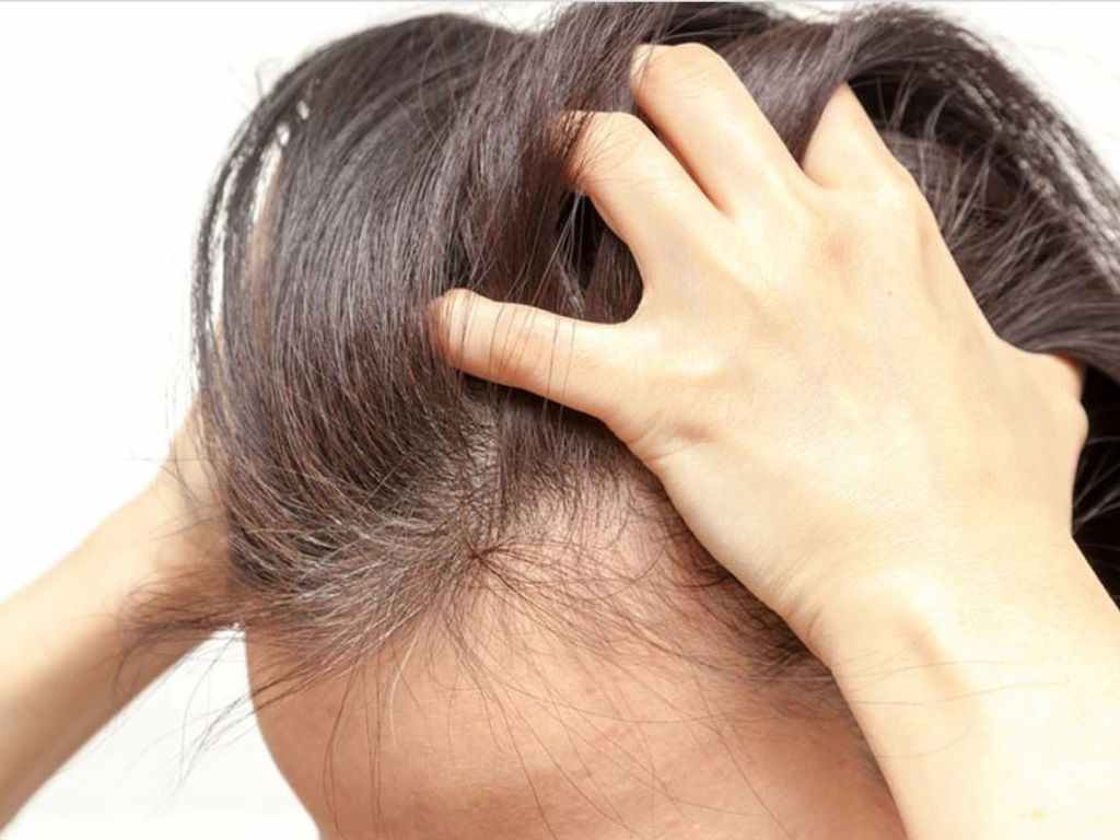 درمان خارش سر با حنا