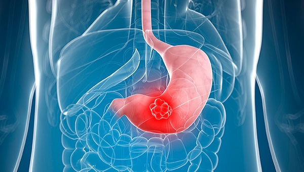 ورم معده مزمن