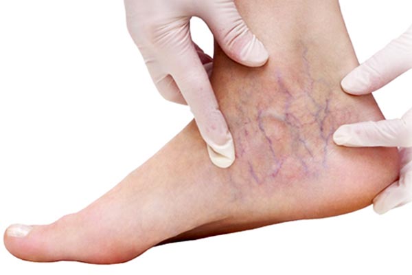 خطرات واریس پا