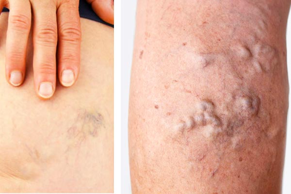 علت واریس پا در جوانی