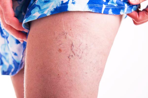 درمان واریس پا با ورزش