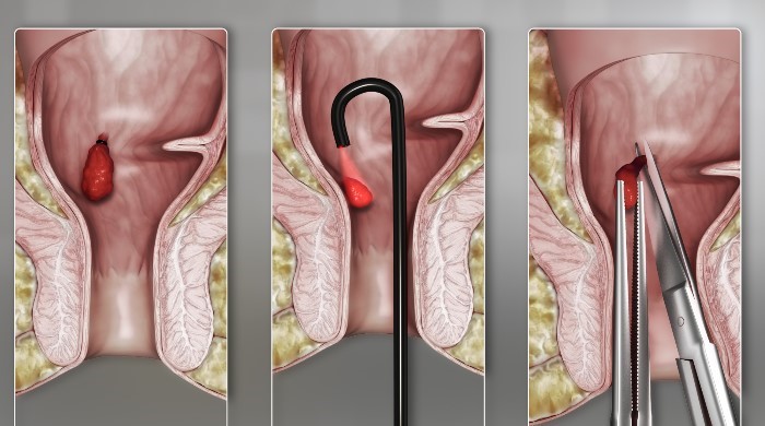روش های درمان بواسیر