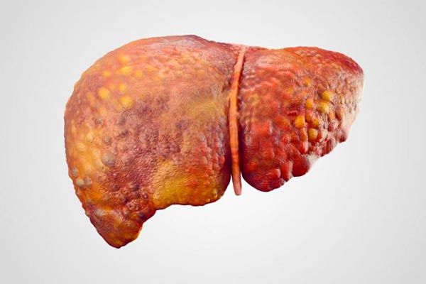  تاثیر الکل بر کبد