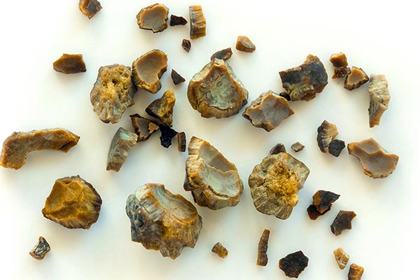  عوارض بعد از دفع سنگ کلیه