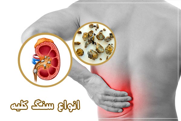 علت بوجود آمدن سنگ کلیه