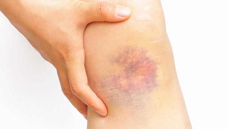 کمبود چه ویتامینی باعث کبودی بدن می‌شود؟