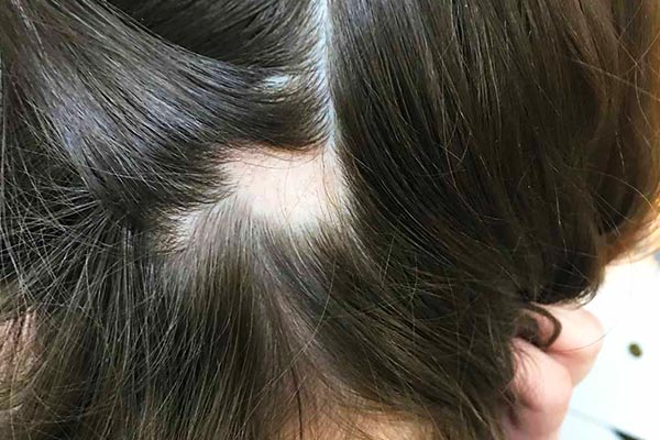 درمان گياهي ريزش مو سكه اي