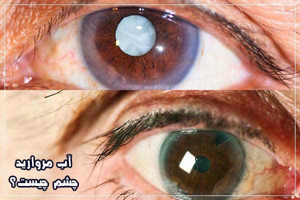 آب مروارید چشم عمل