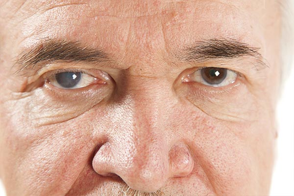 آب مروارید چشم