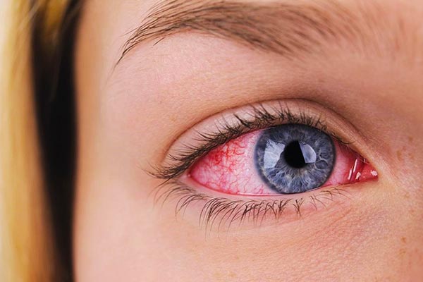 علت احساس اشغال در چشم