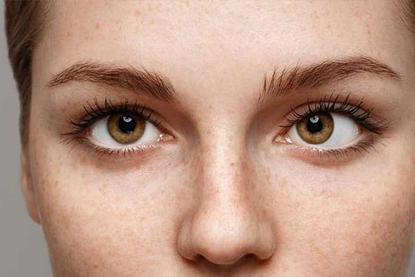 آیا عمل انحراف چشم خطرناک است