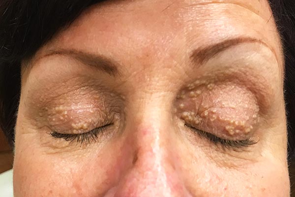 تخلیه میلیا