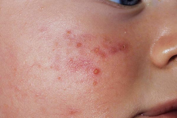 میلیا در نوزادان